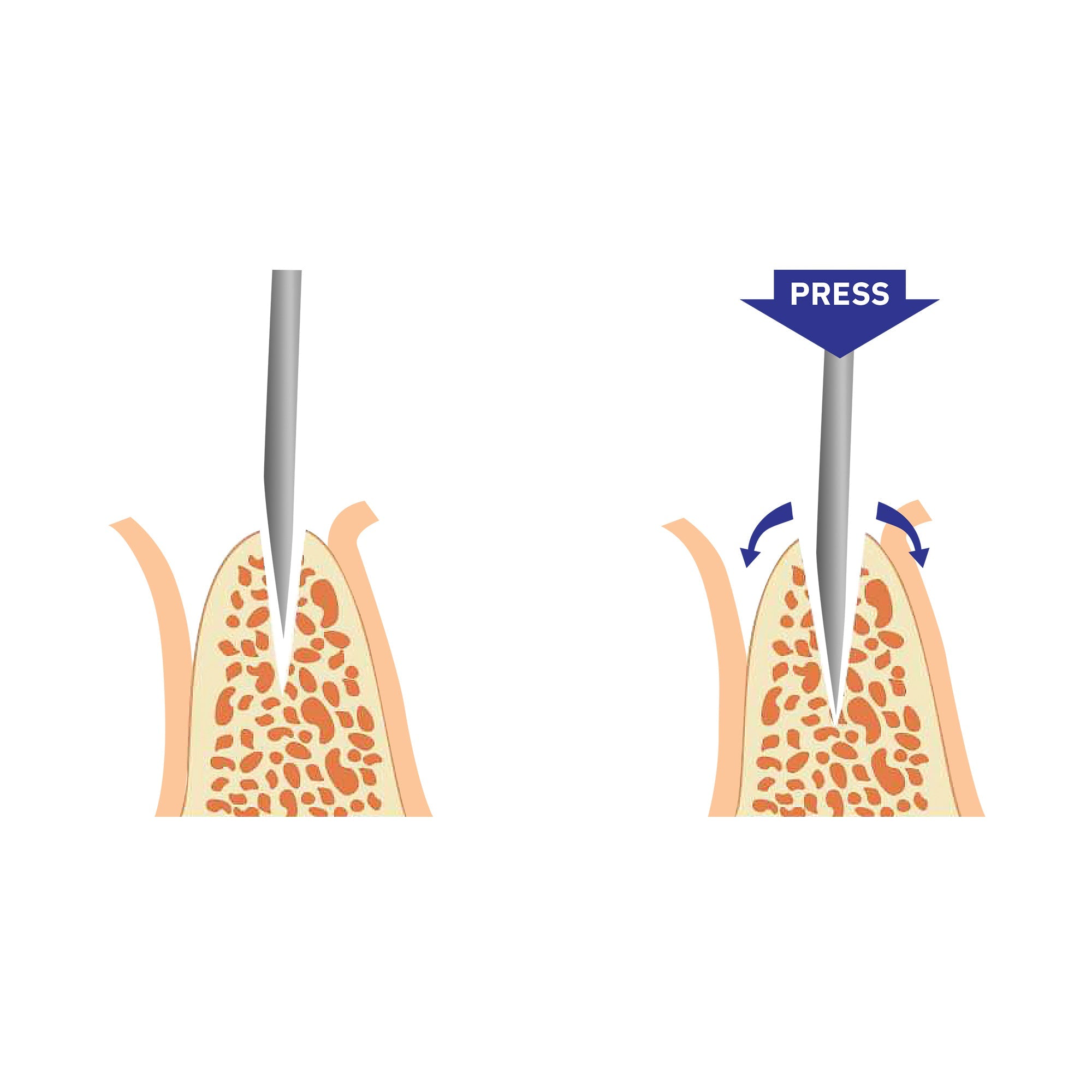 DIP Ridge Split Chisel Bone Expander_4