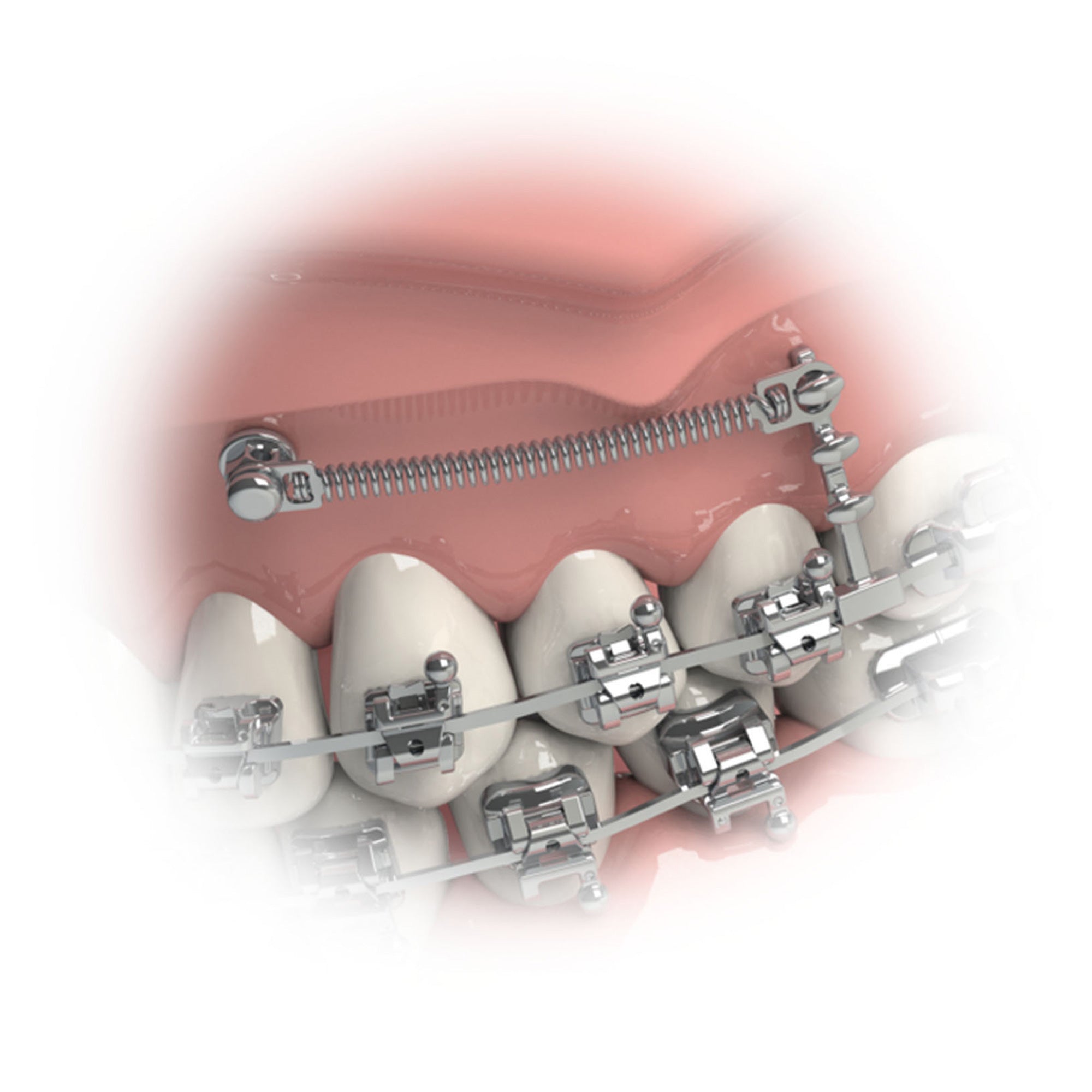 Morelli Orthodontic Universal Triple Hook For TAD Miniscrew_3