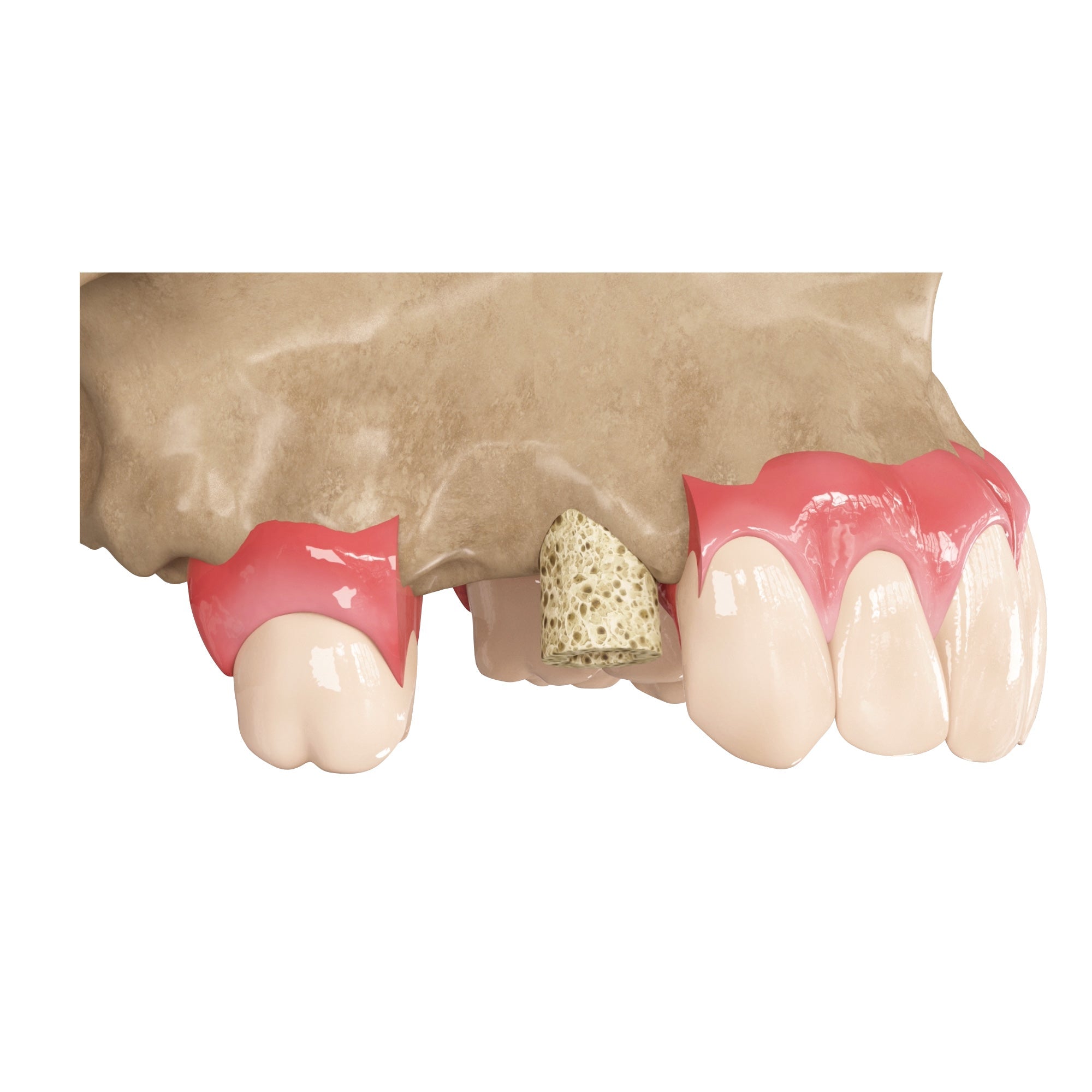 Zenoss Bovine Natural Dental Bone Graft Ring For Single Stage Implantation_7