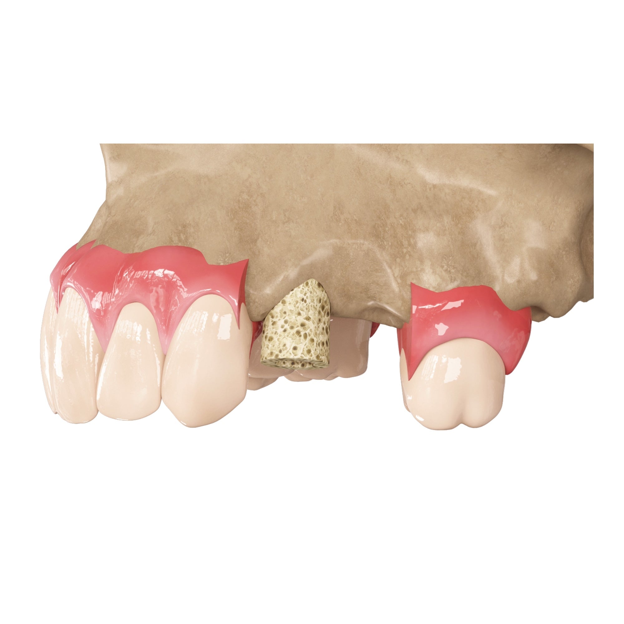 Zenoss Bovine Natural Dental Bone Graft Ring For Single Stage Implantation_6