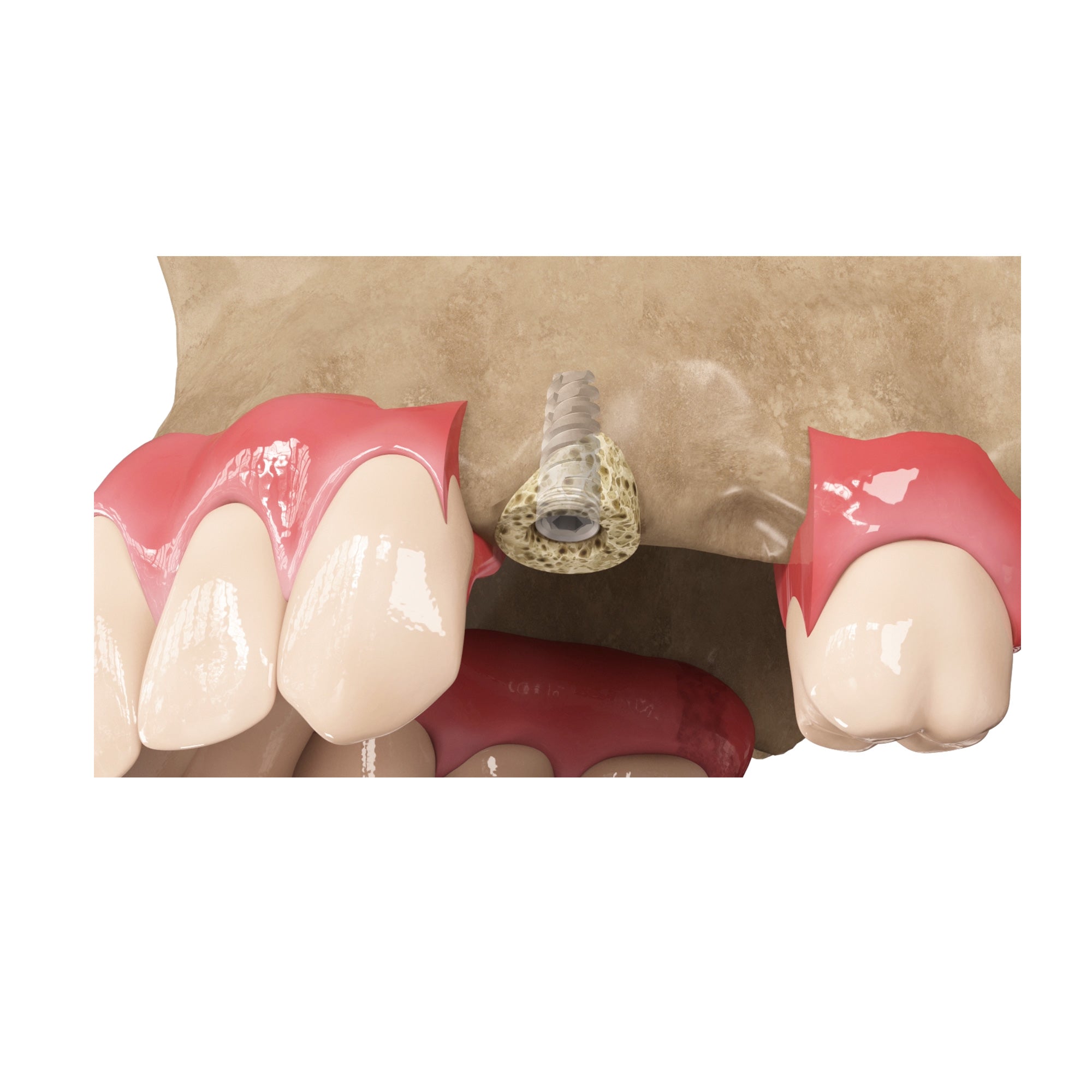 Zenoss Bovine Natural Dental Bone Graft Ring For Single Stage Implantation_5