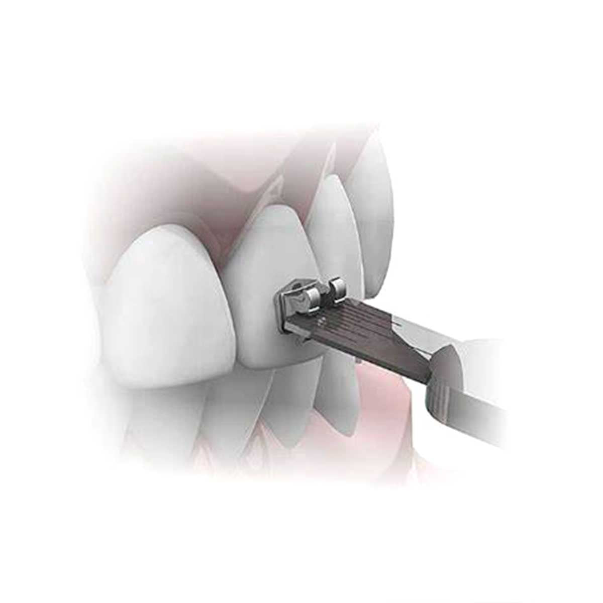 Stainless steel orthodontic bracket tweezer with aligning blade
