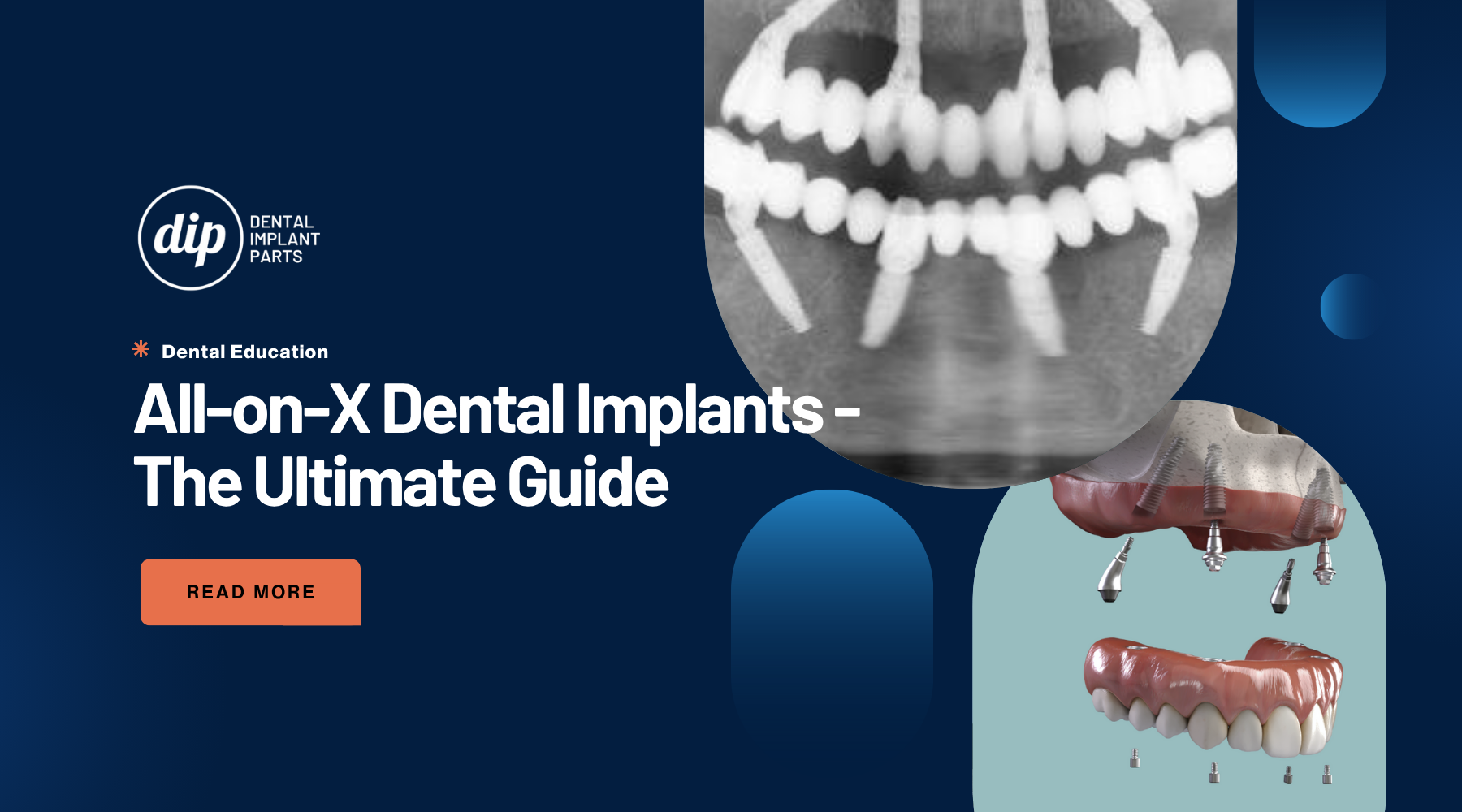 All-on-X Dental Implants - The Ultimate Guide