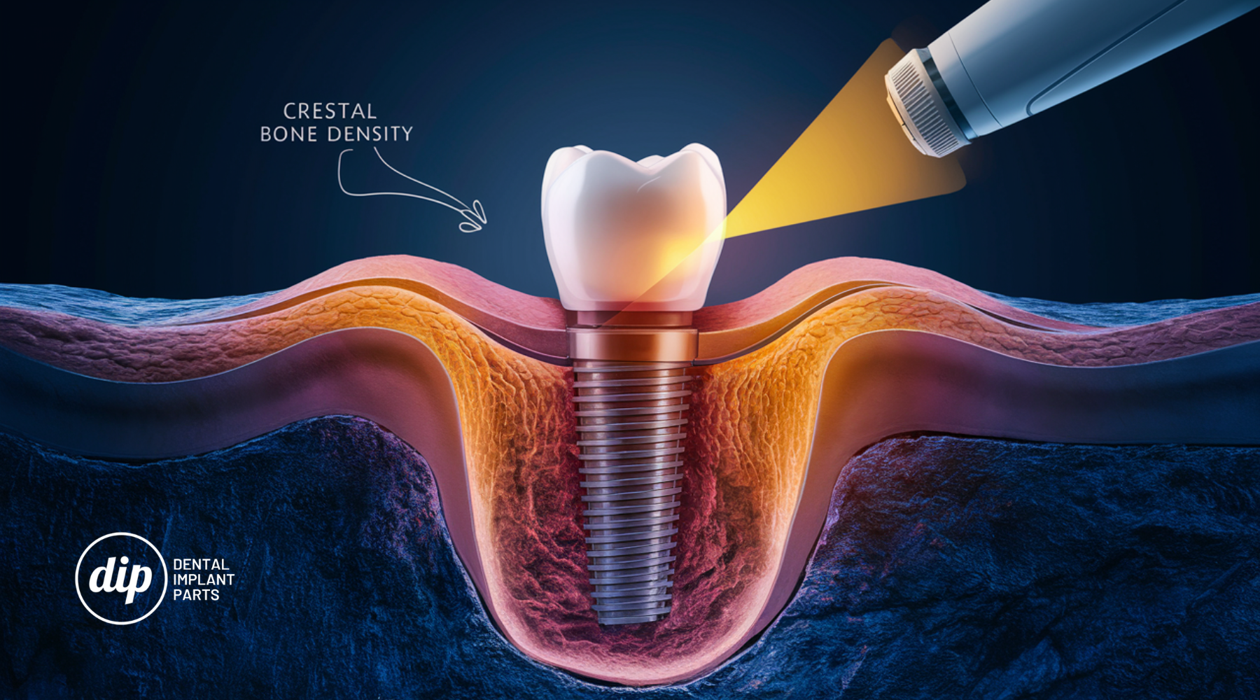 Effect of Photobiomodulation on Crestal Bone Density Around Dental Implants