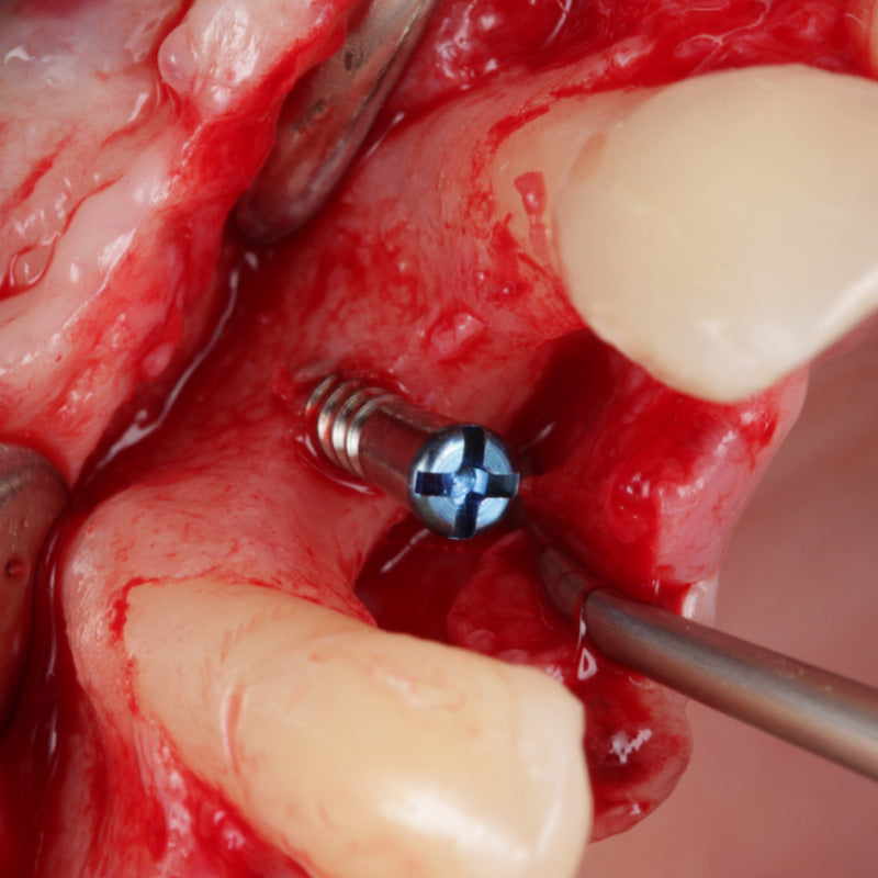 DSI New Tenting 2-component Screw For Membrane Fixation Ø2.0mm