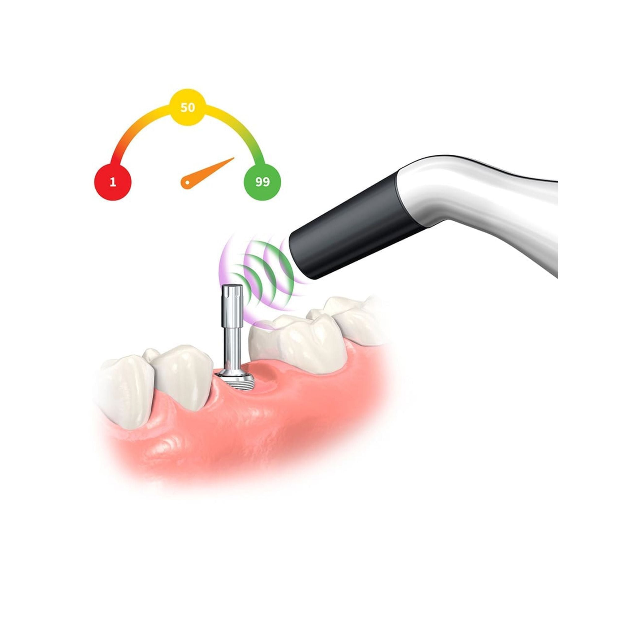 Penguin II Implant Stability And Osseointegration Tester