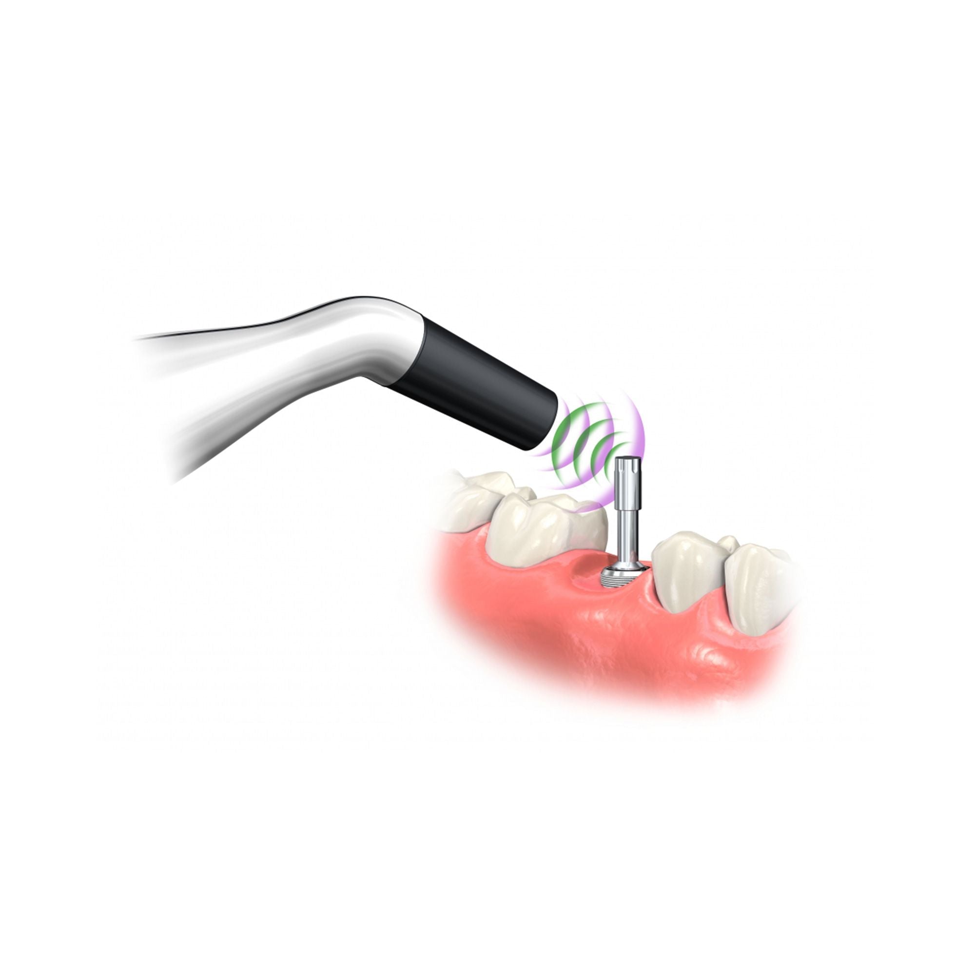 Penguin II Implant Stability And Osseointegration Tester