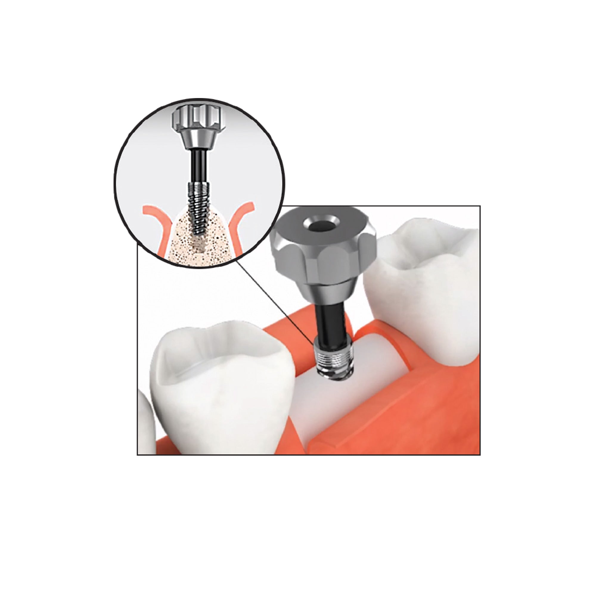 DIP DS-RKS Kit For Broken Implant Fixture & Screw Removal Extraction