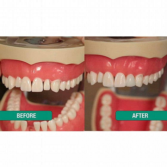 ContacEZ White Strips For Veneers