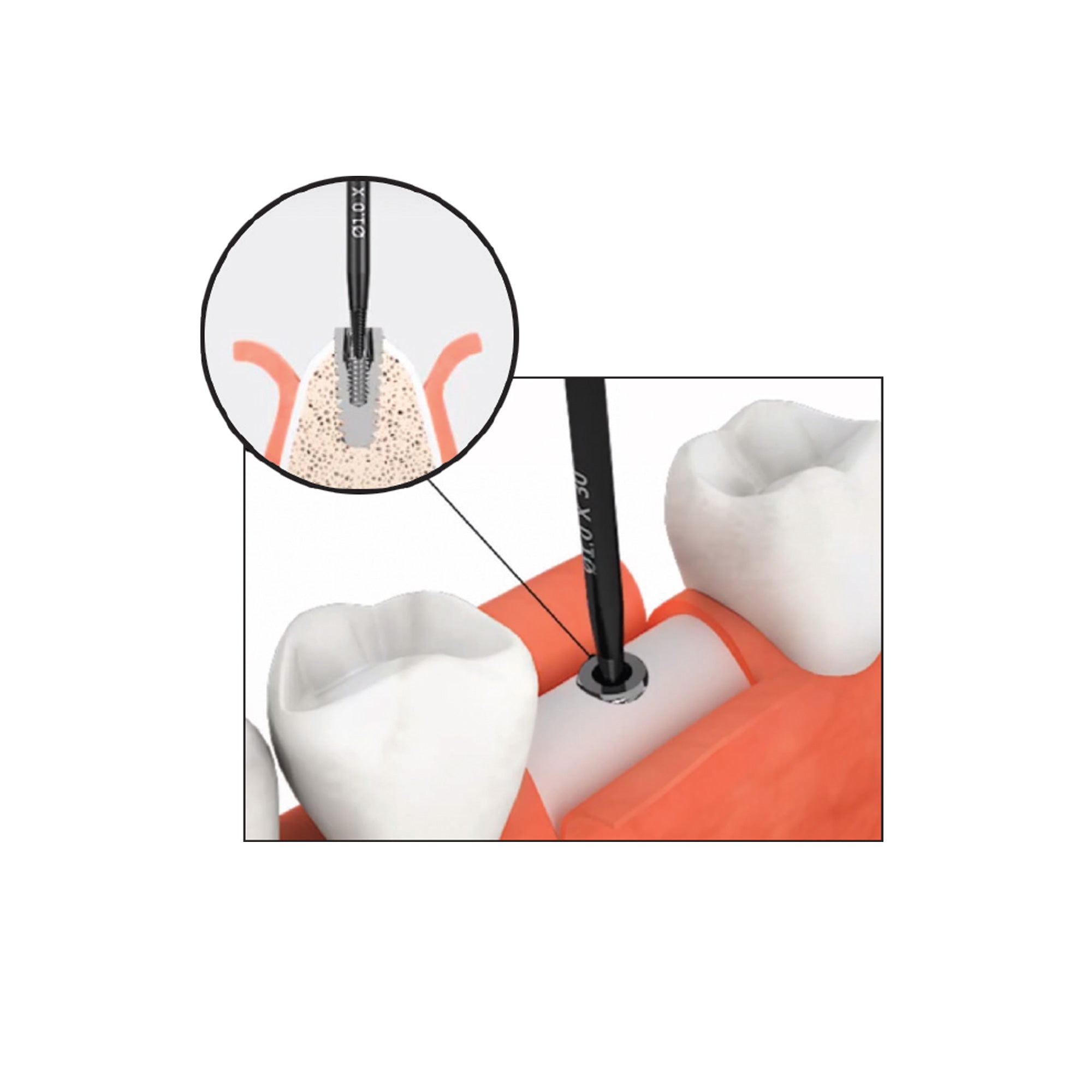 DIP DS-RKS Kit For Broken Implant Fixture & Screw Removal Extraction