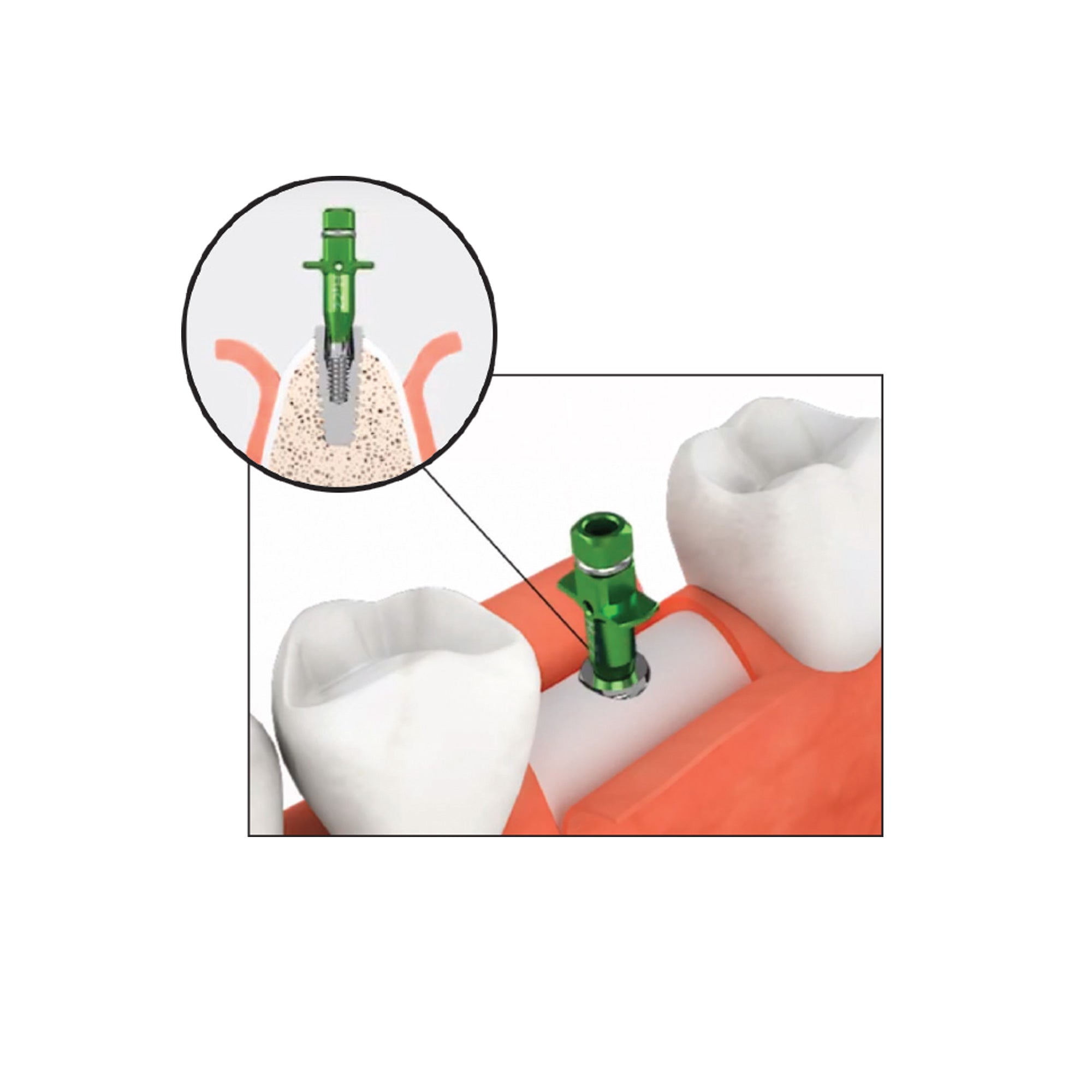 DIP DS-RKS Kit For Broken Implant Fixture & Screw Removal Extraction