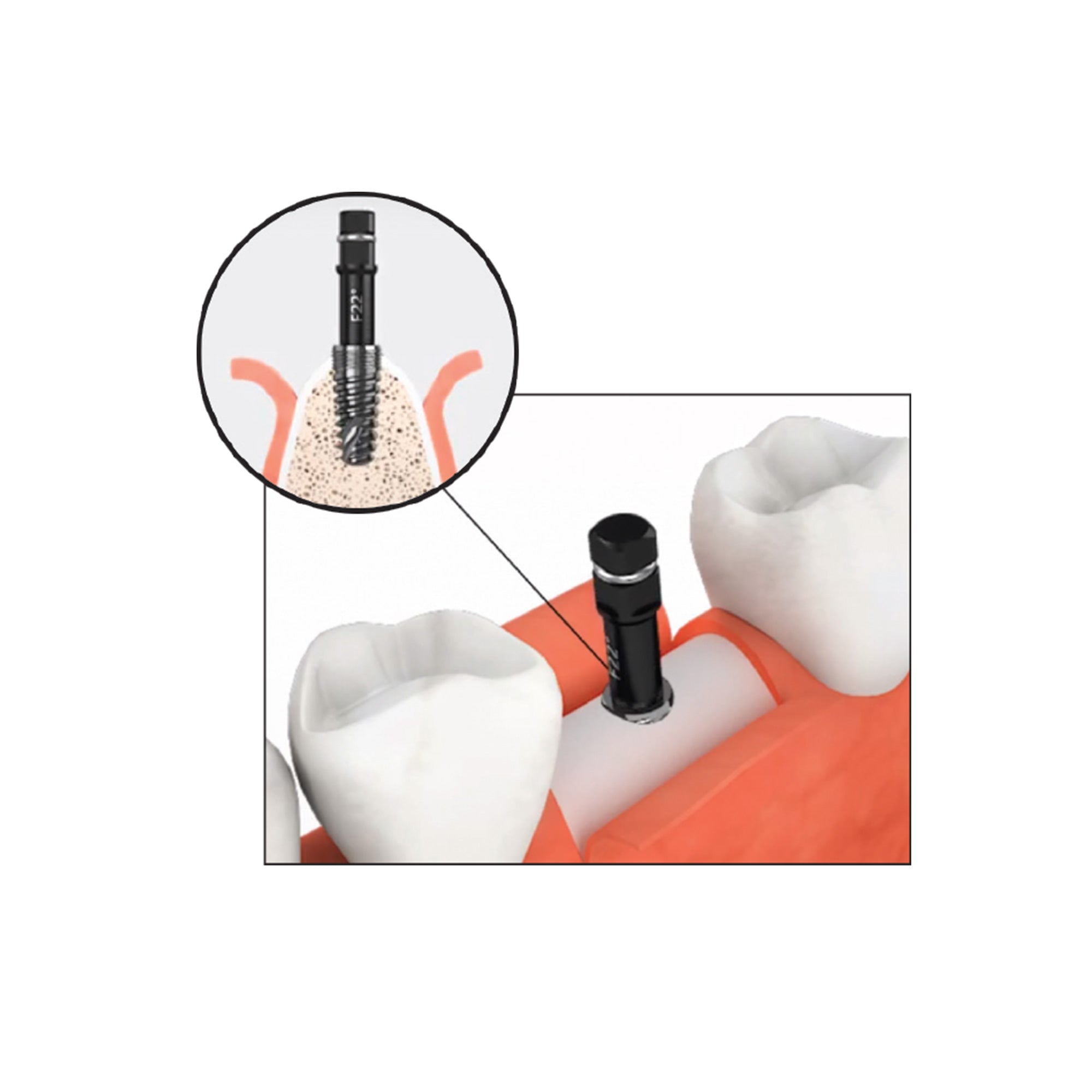 DSI Implant Extraction Removal Drills (DS-RKS refill)