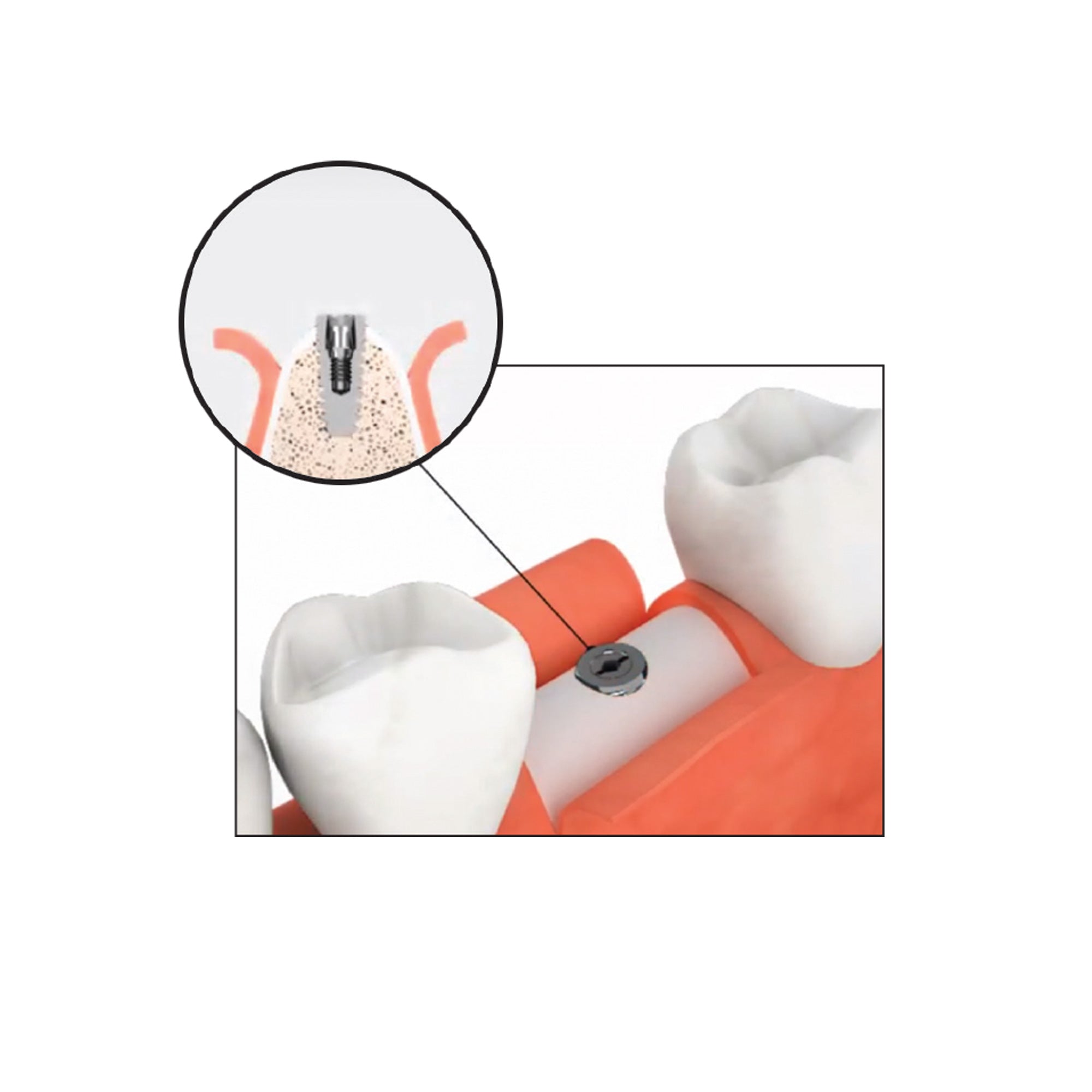 DSI DS-RKS Kit For Broken Implant Fixture & Screw Removal Extraction