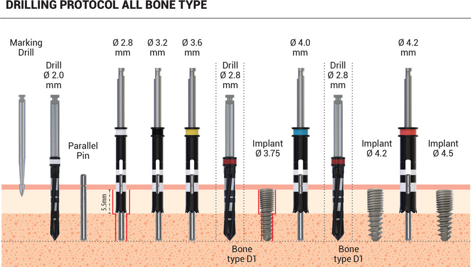 DIP Smart Dual Thread Spiral Implant - Internal Hex