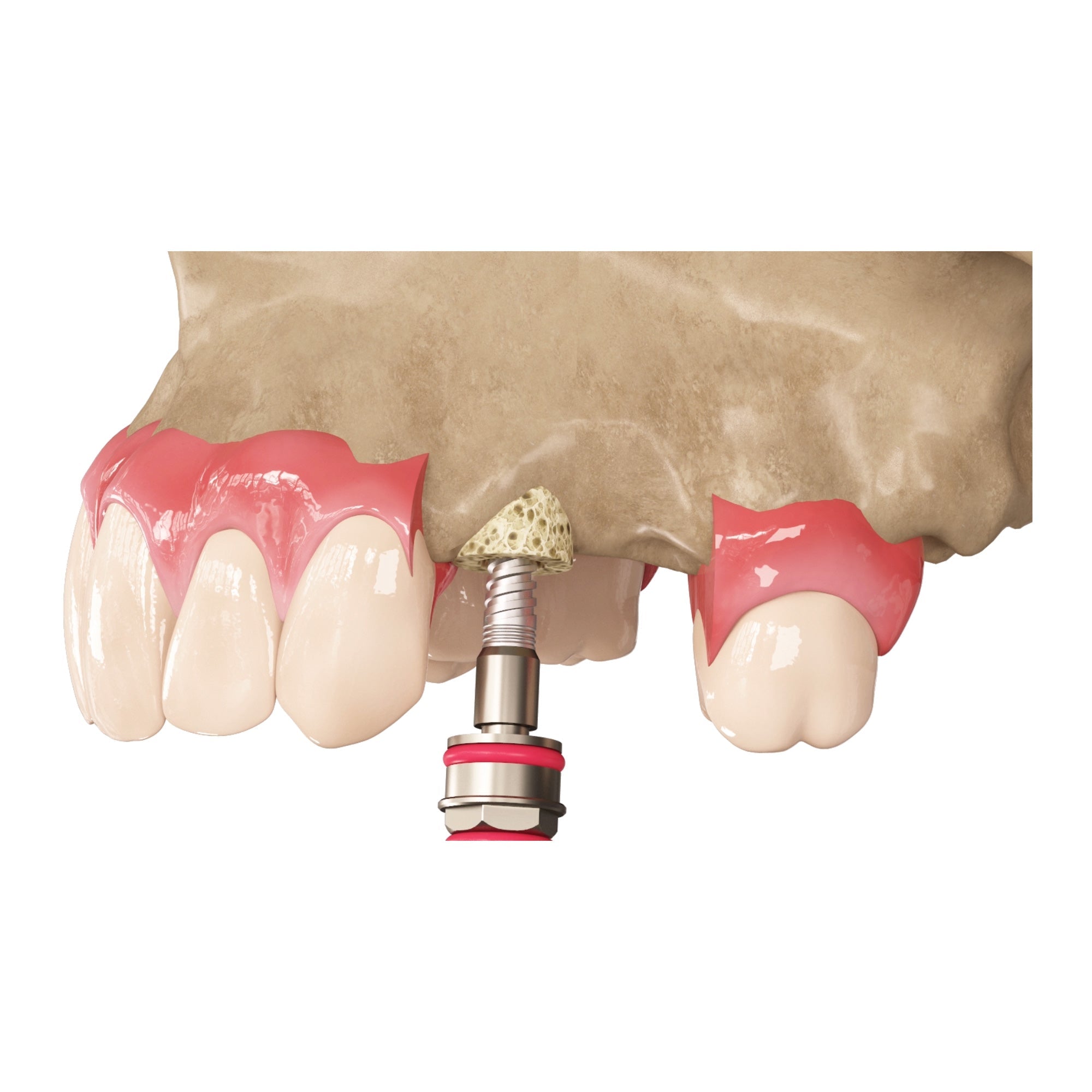 DIP Zenoss Bovine Natural Bone Graft Ring For Single Stage Implantation