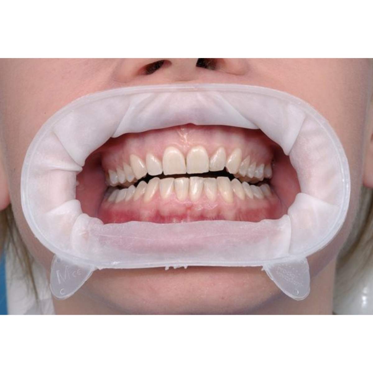 Ivoclar Optragate Lip and Cheek Retractor