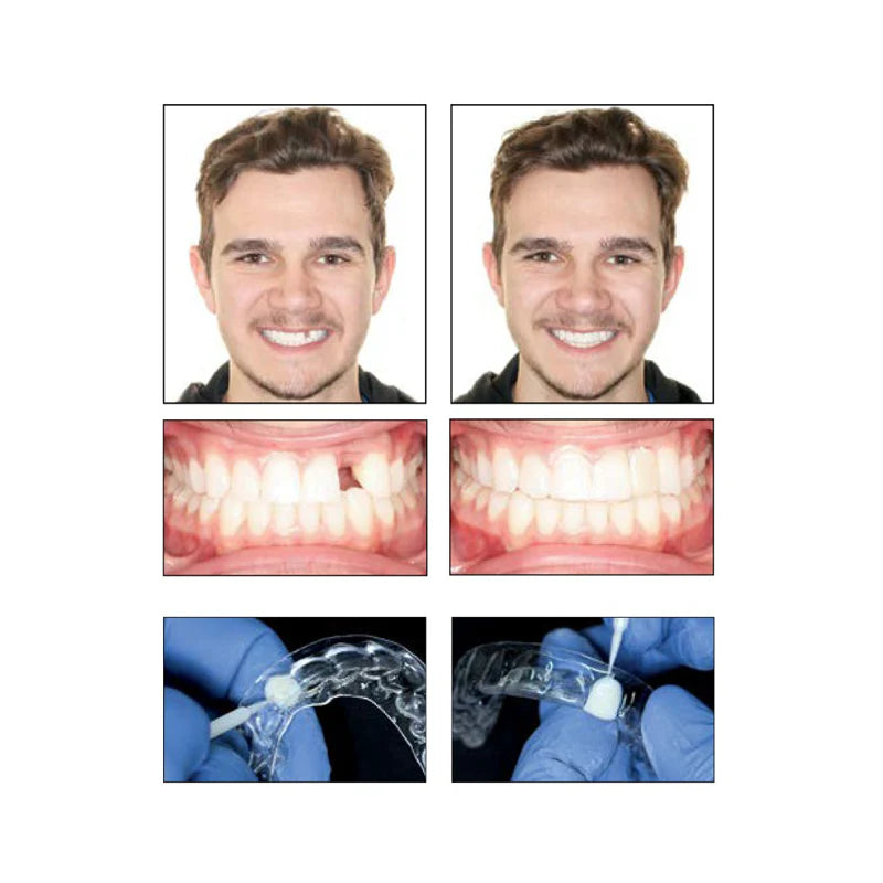 Light-Cured & Fast – Instant aesthetic fix without lab delays.